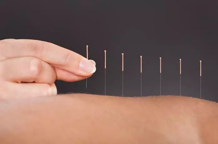 Acupuncture For Stroke Recovery