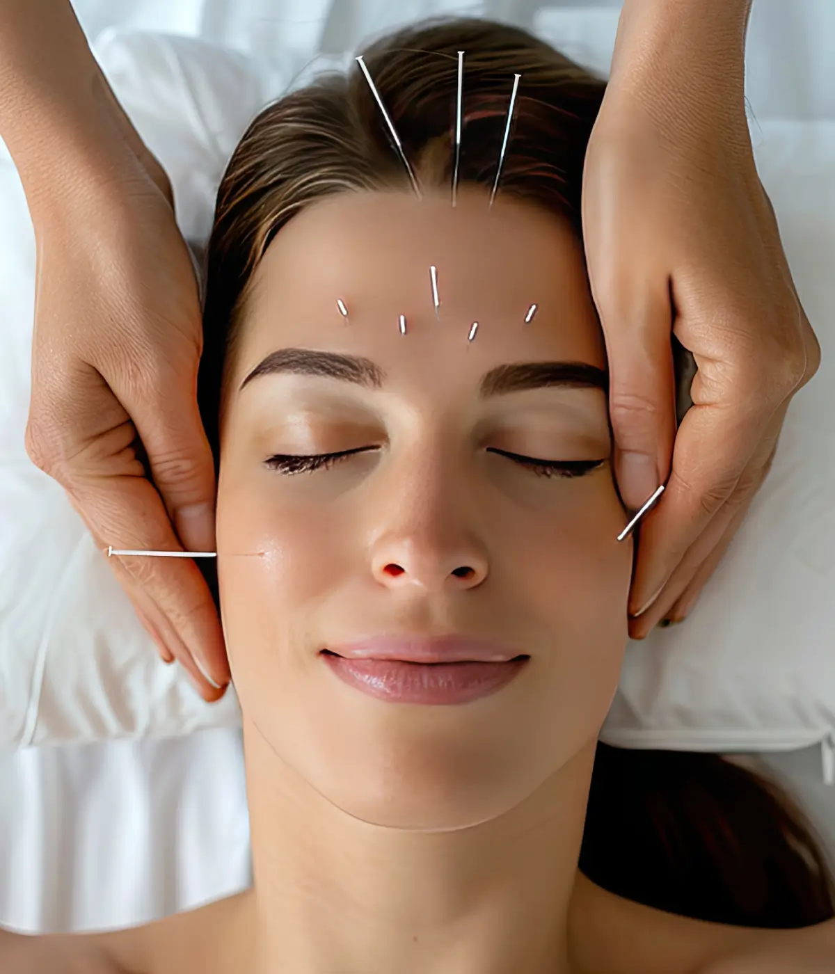 Cosmetic Acupuncture image (1)